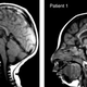 What microcephaly does to the brain.